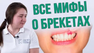 Мифы о брекетах: что правда, а что давно устарело