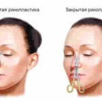 Ринопластика — больше, чем изменение внешности: когда операция действительно нужна