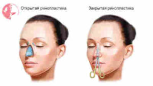 Ринопластика — больше, чем изменение внешности: когда операция действительно нужна